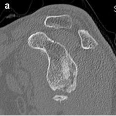 Posterior Glenoid Deficiency Sagittal